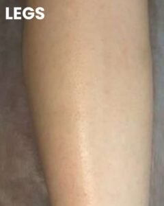 Leg after laser hair removal