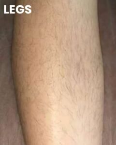 Leg before laser hair removal